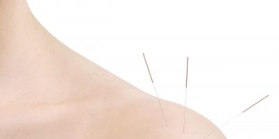 Young woman undergoing acupuncture treatment. Needes in the shoulder.